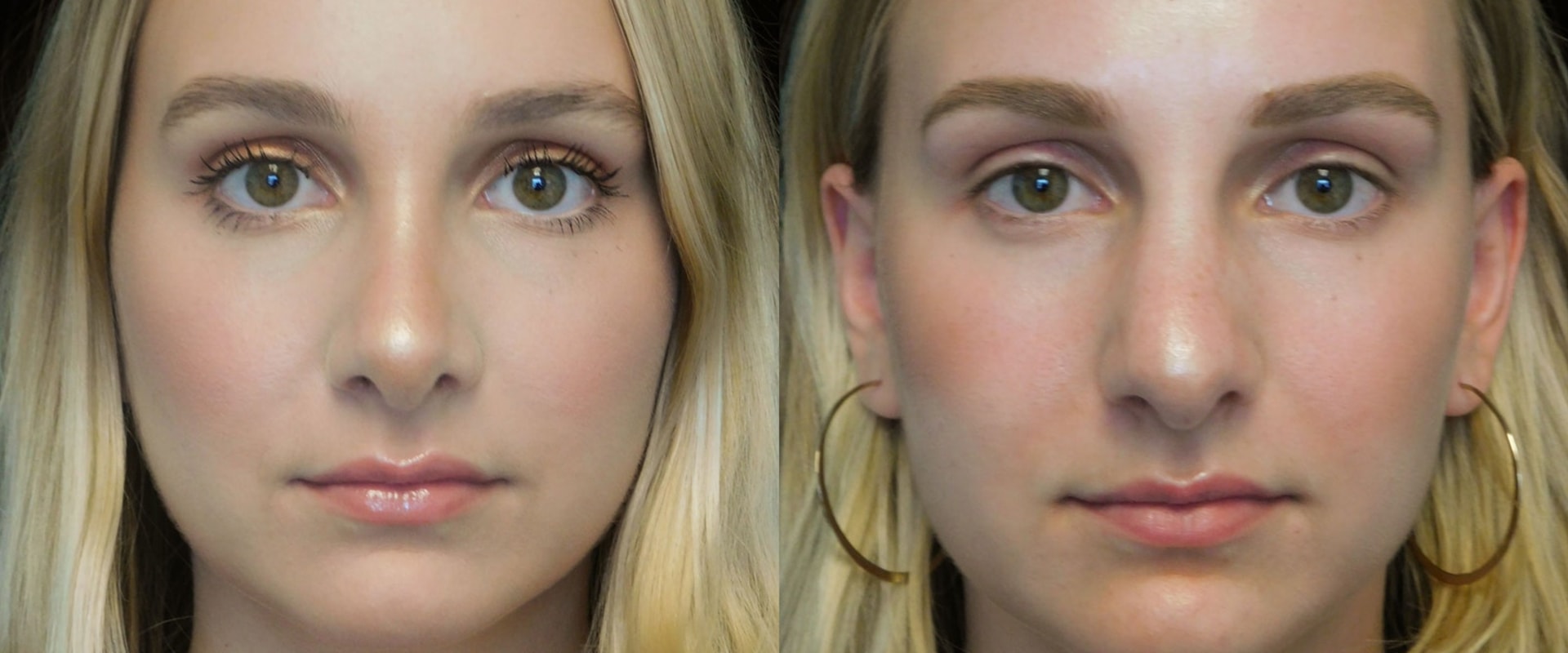 Everything You Need to Know About Rhinoplasty