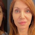 Understanding Blepharoplasty: All You Need to Know About This Facial Procedure